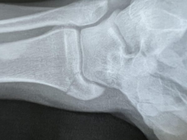 The victim’s x-ray which was taken at Community Hospital. A broken fibula is identifiable.